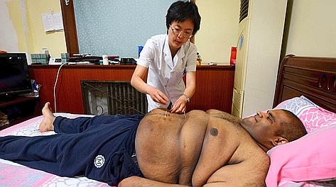Un paziente alle prese con l'obesit. Afp